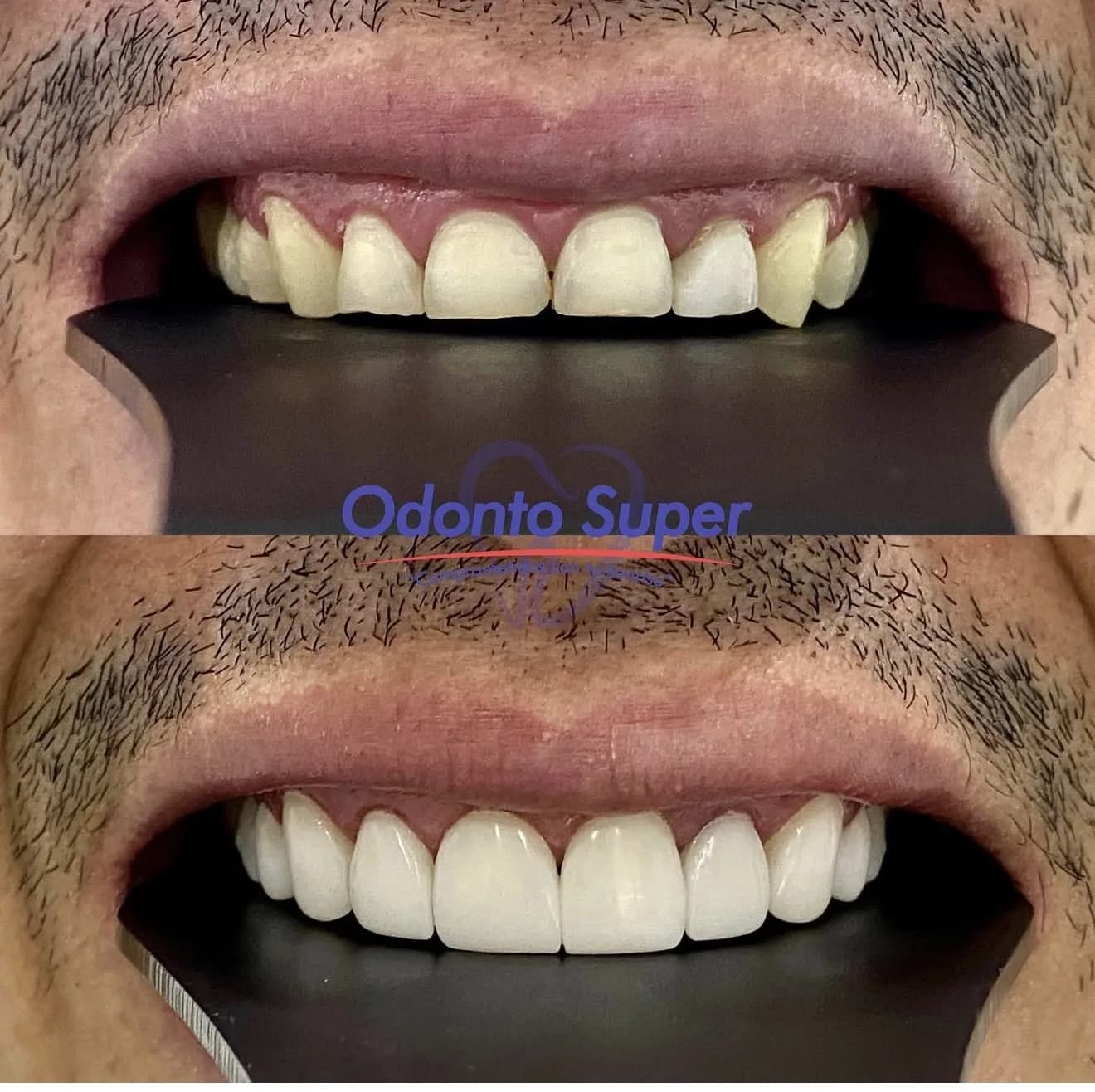 Real before and after veneer result behind the full treatment quote.