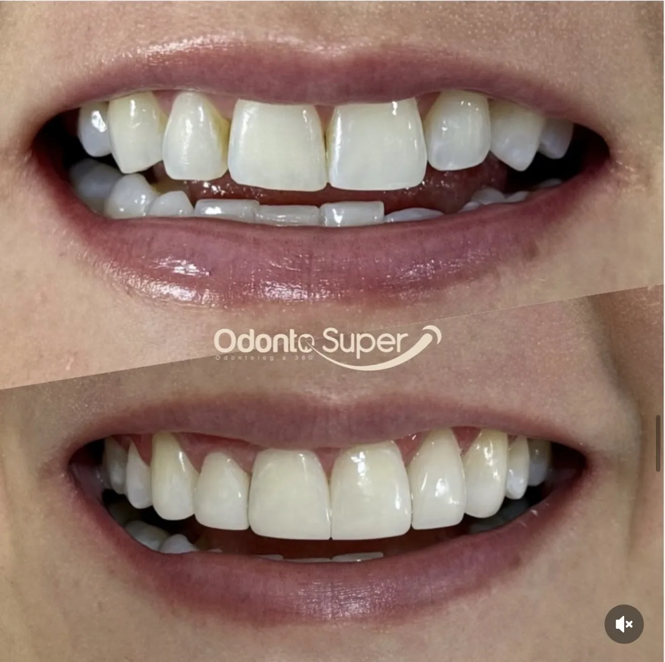 Documented hand-finished porcelain veneer result from the clinic.
