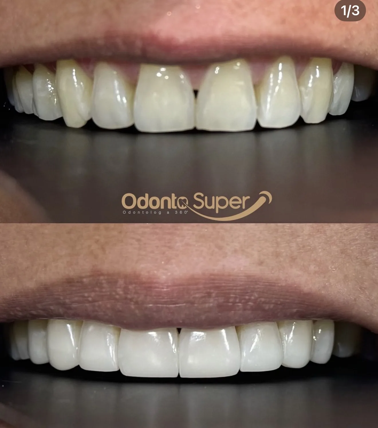 Conservative veneer result preserving a natural look on a real patient.