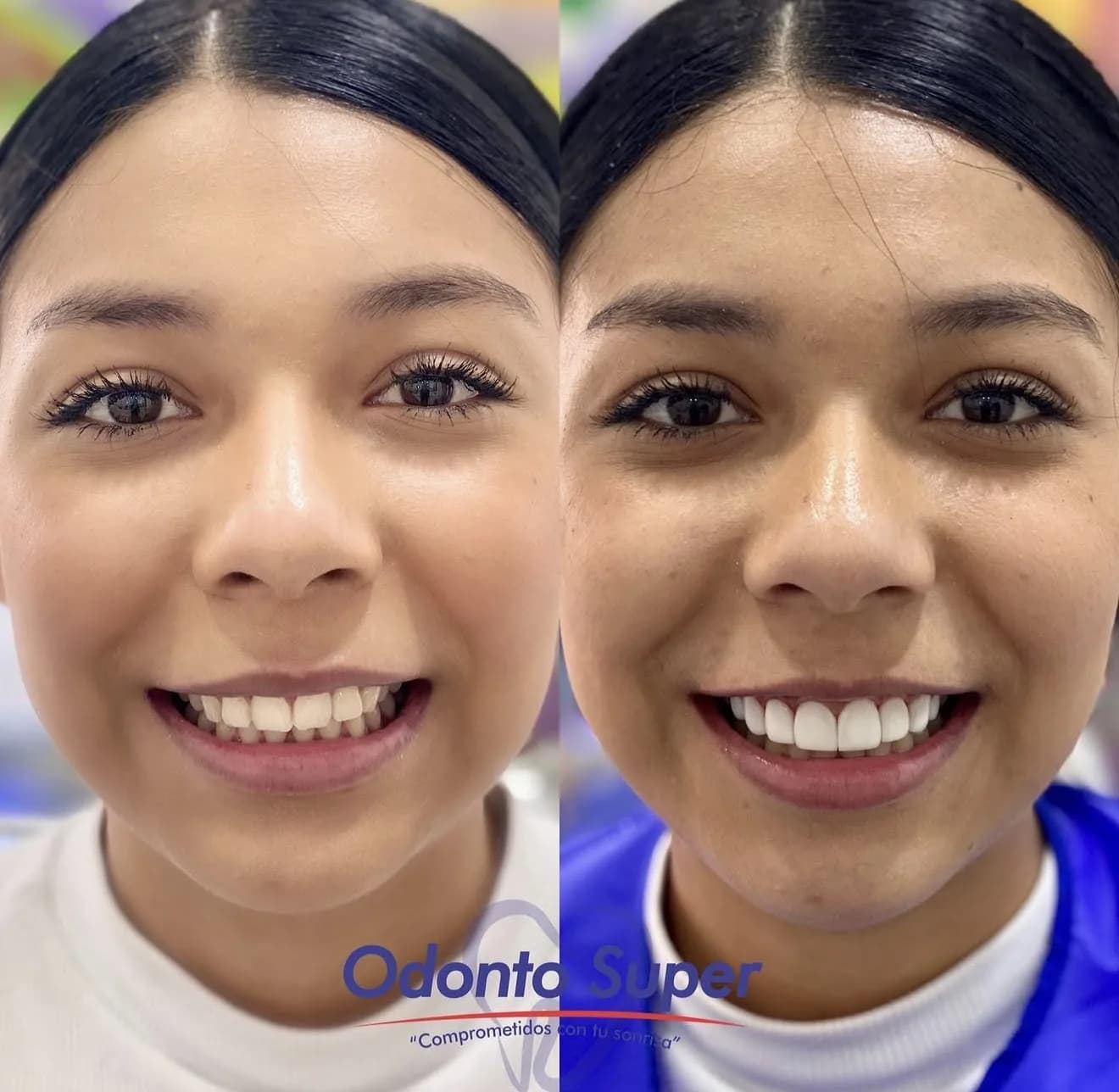Real patient before and after veneer candidacy assessment and treatment.