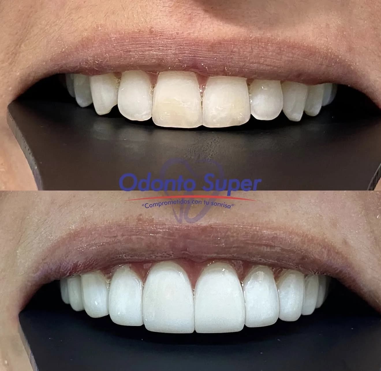 Real before and after veneer results showing different smile outcomes