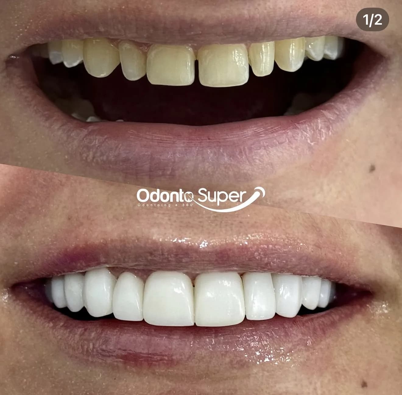 Real patient result after the full veneer treatment plan.